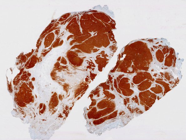 2D1 Encephalocoele & Complex Malformation (Case 2) SYN whole mount 1 (2)