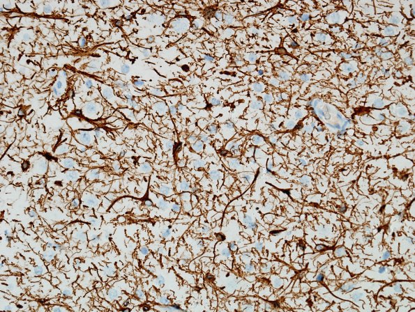 2D10 Encephalocoele & Complex Malformation (Case 2) A8 GFAP 1