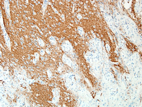 2D3 Encephalocoele & Complex Malformation (Case 2) A8 SYN 6