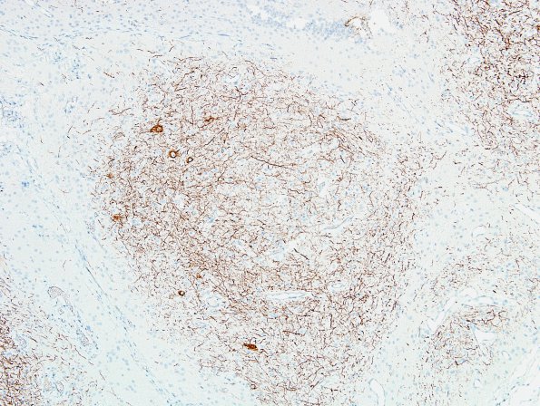 2D7 Encephalocoele & Complex Malformation (Case 2) A8 NF 11