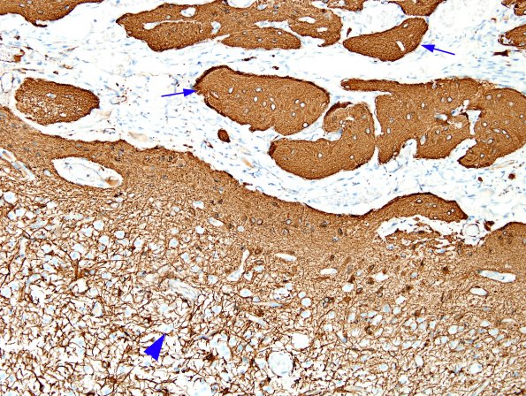 2D9 Encephalocoele & Complex Malformation (Case 2) A8 GFAP 7A