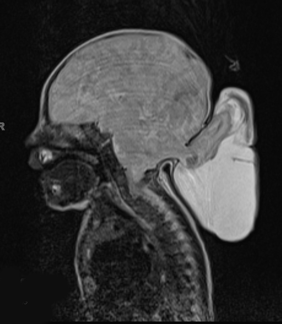 1A1 Encephalocele & Klippel-Feil (Case 1) T2