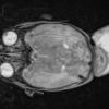 1A2 Encephalocele & Klippel-Feil (Case 1) T2 STEALTH