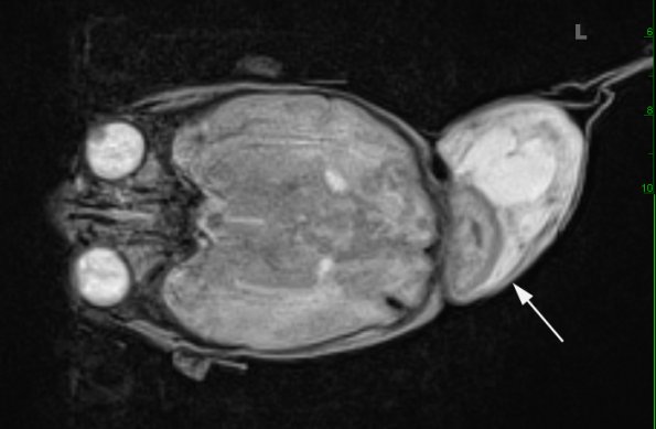 1A2 Encephalocele & Klippel-Feil (Case 1) T2 STEALTH