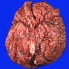 1B1 Encephalocele, complex, Klippel-Feil (Case 1) _1A