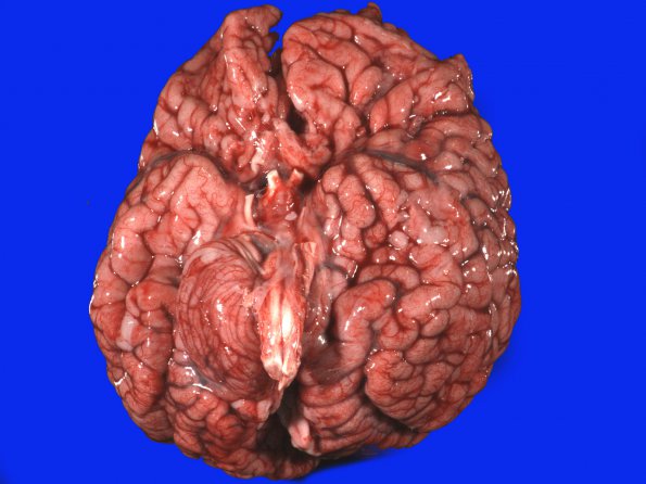 1B1 Encephalocele, complex, Klippel-Feil (Case 1) _1A