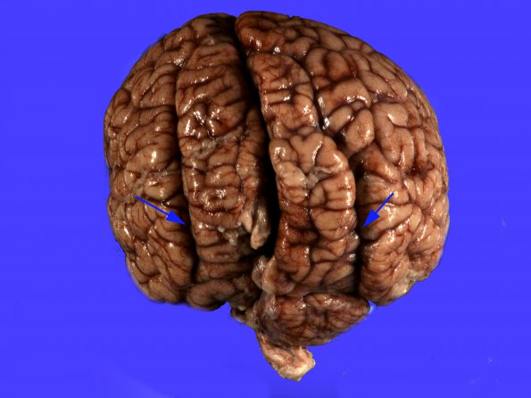 1B2 Encephalocele, complex, Klippel-Feil (Case 1) _3