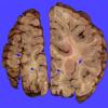 1B3 Encephalocele, complex, Klippel-Feil (Case 1) _8