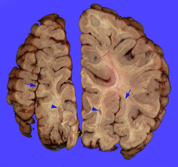 1B3 Encephalocele, complex, Klippel-Feil (Case 1) _8