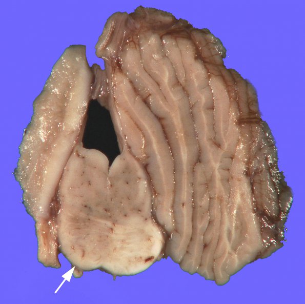 1C1 Encephalocele, complex, Klippel-Feil (Case 1) _5A