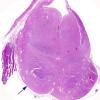 1C2 Encephalocele & Klippel-Feil (Case 1) N7 1 H&E