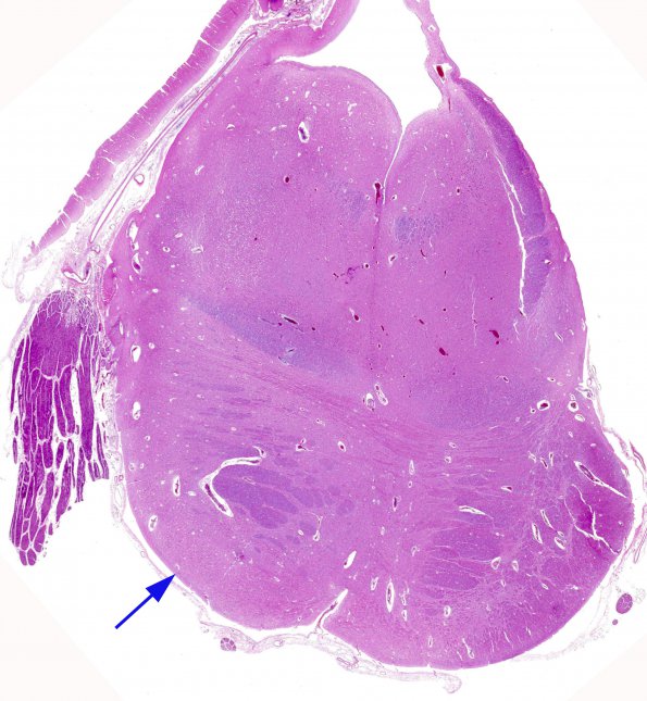 1C2 Encephalocele & Klippel-Feil (Case 1) N7 1 H&E