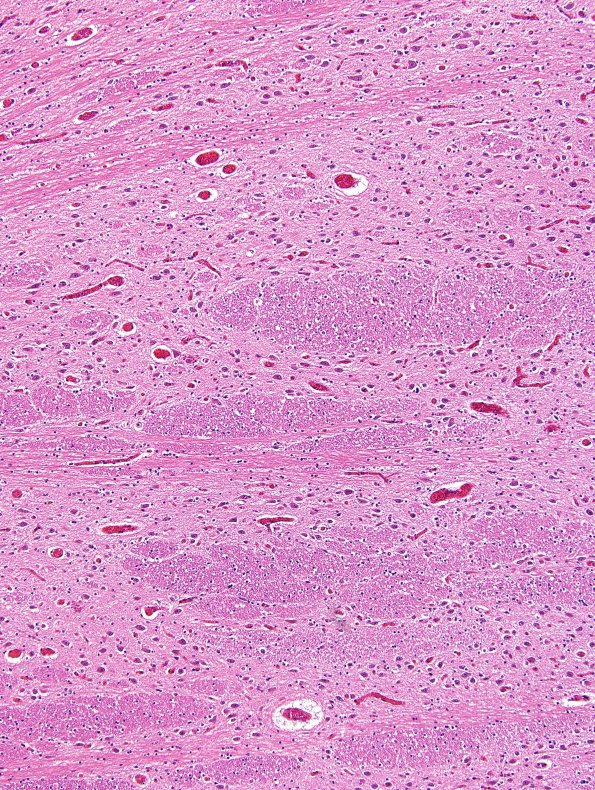 1C3 Malformation, Klippel-Feil (Case 1) N7 Pons Left