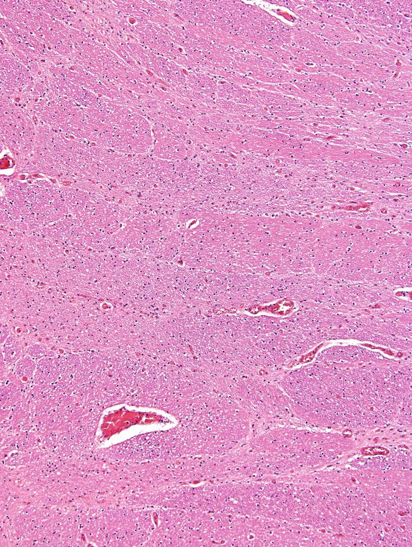 1C4 Malformation, Klippel-Feil (Case 1) N7 Pons Right