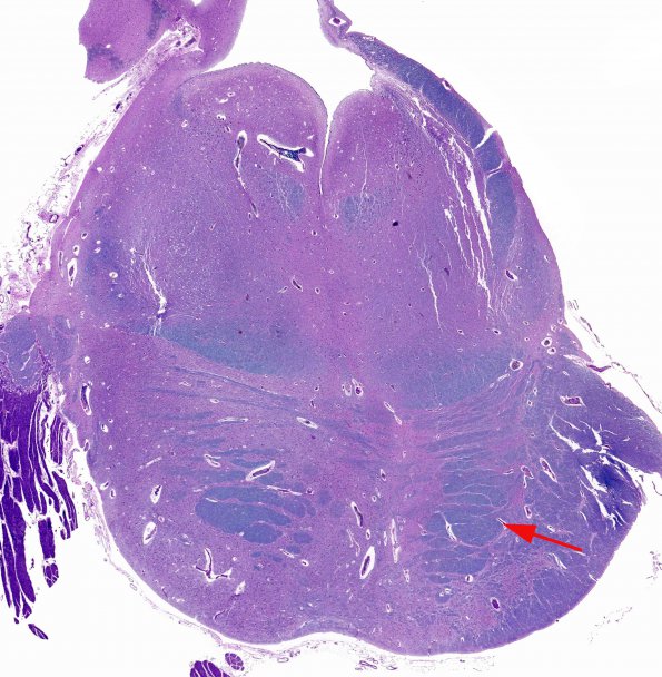 1C5 Encephalocele & Klippel-Feil (Case 1) N7 1 LFB-PAS