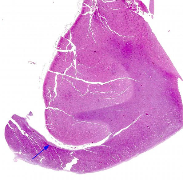 1D1 Encephalocele & Klippel-Feil (Case 1) indusium griseum H&E