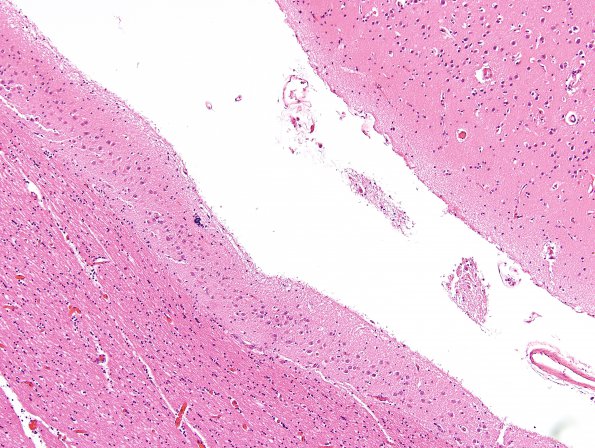 1D2 Encephalocele & Klippel-Feil (Case 1) indusium griseum H&E 2