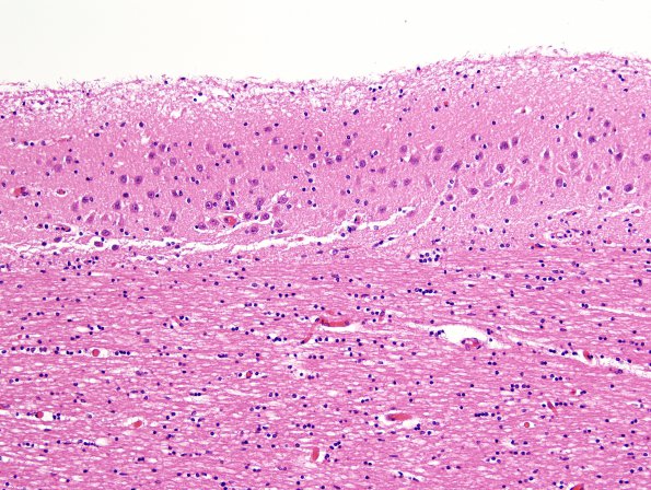 1D3 Encephalocele & Klippel-Feil (Case 1) indusium griseum H&E 1