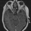 1A1 Encephalocoele (Nasal Glioma) (Case 1) T1 3D 2 copy