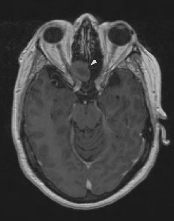 1A1 Encephalocoele (Nasal Glioma) (Case 1) T1 3D 2 copy