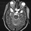 1A2 Encephalocoele (Nasal Glioma) (Case 1) T2