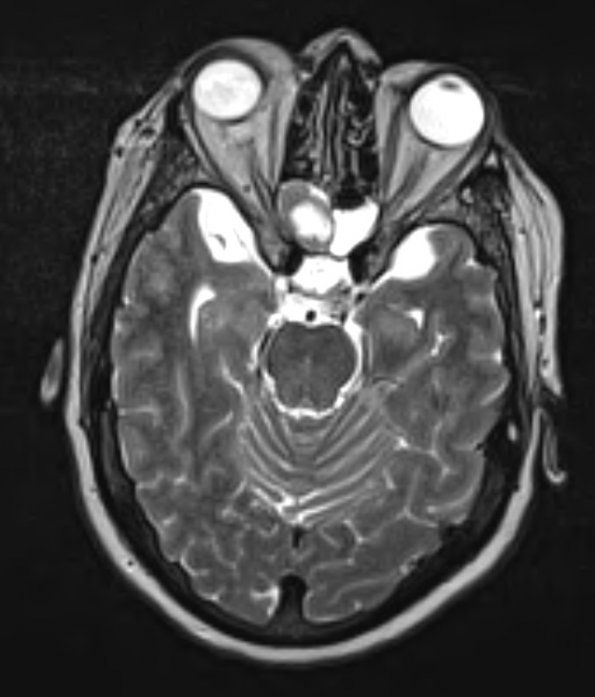 1A2 Encephalocoele (Nasal Glioma) (Case 1) T2