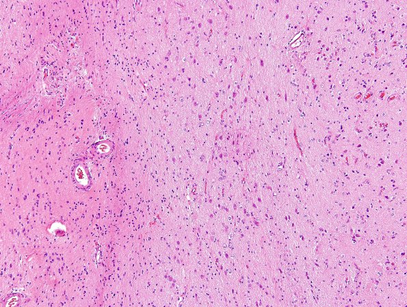 1B1 Encephalocoele (Nasal Glioma) (Case 1) H&E 1