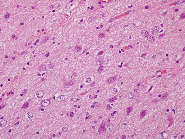 1B2 Encephalocoele (Nasal Glioma) (Case 1) H&E 2