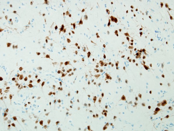 1C3 Encephalocoele (Nasal Glioma) (Case 1)  NeuN 1