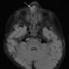 2A1 Encephalocele (Case 2) FLAIR 1