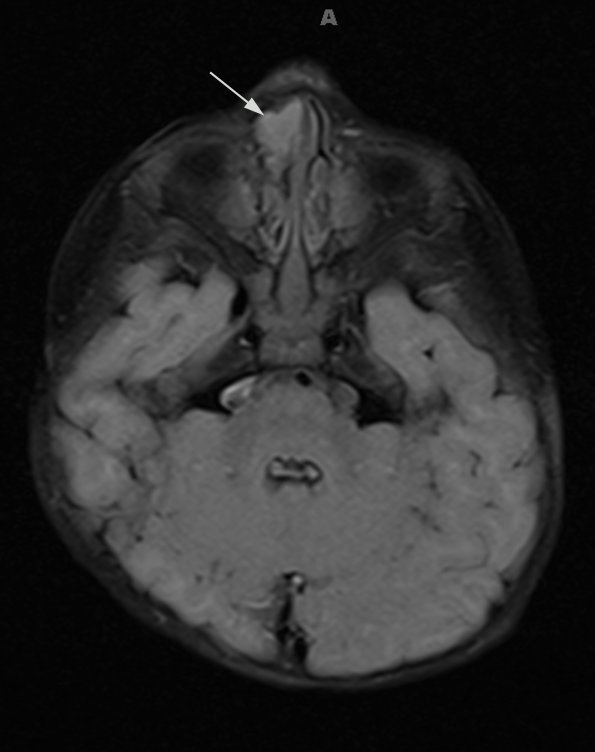 2A1 Encephalocele (Case 2) FLAIR 1