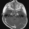 2A2 Encephalocele (Case 2) T1 W