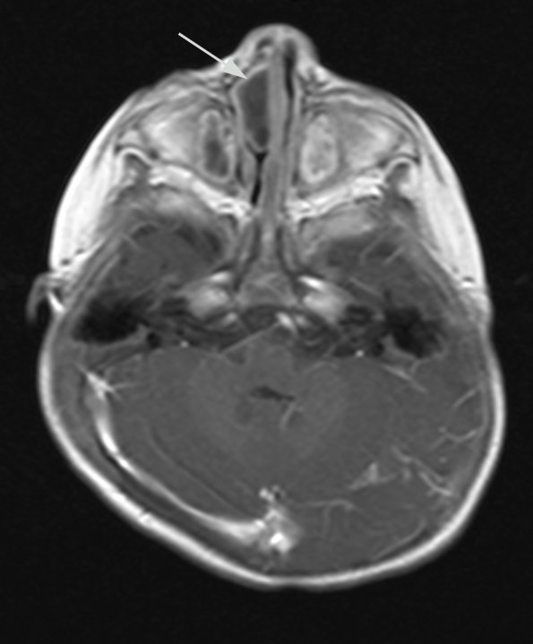 2A2 Encephalocele (Case 2) T1 W