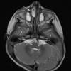 2A3 Encephalocele (Case 2) T2 1