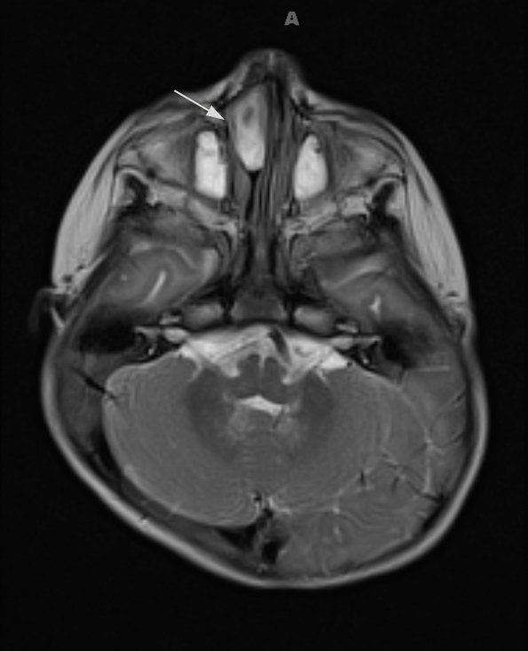 2A3 Encephalocele (Case 2) T2 1