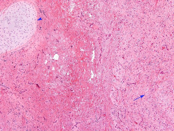 2B1 Nasal Glioma (Case 2) H&E 7