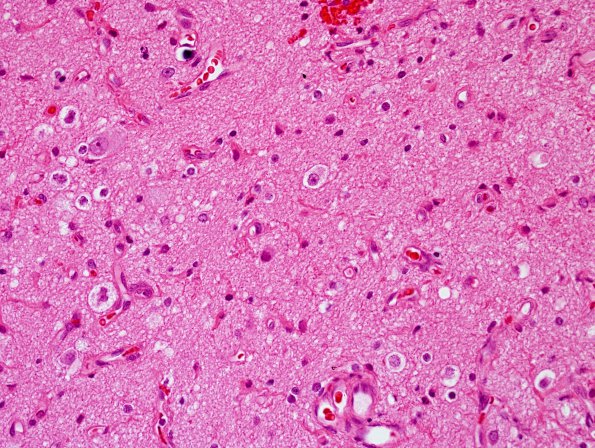 2B2 Nasal Glioma (Case 2) H&E 1