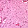 2B3 Nasal Glioma (Case 2) H&E 2