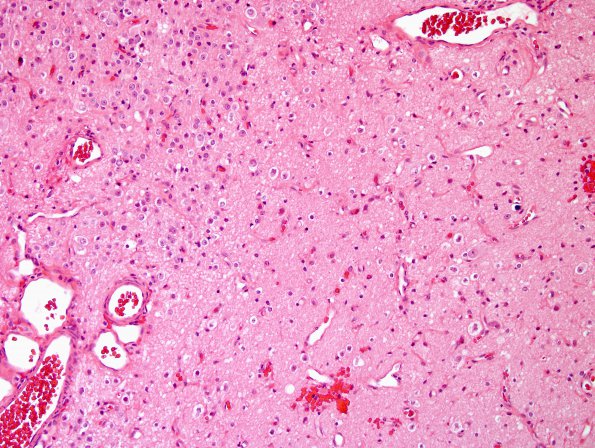 2B3 Nasal Glioma (Case 2) H&E 2