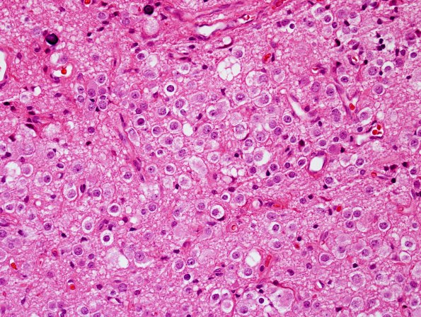 2B4 Nasal Glioma (Case 2) H&E 6