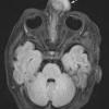 3A1 Encephalocele (no brain connection) Nasal Glioma (Case 3) FLAIR