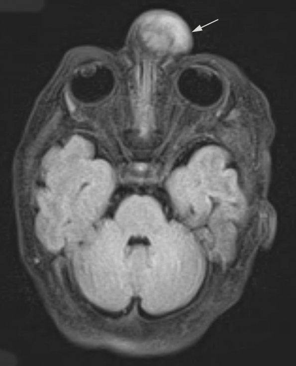 3A1 Encephalocele (no brain connection) Nasal Glioma (Case 3) FLAIR