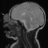 3A2 Encephalocele (no brain connection) Nasal Glioma (Case 3) T2