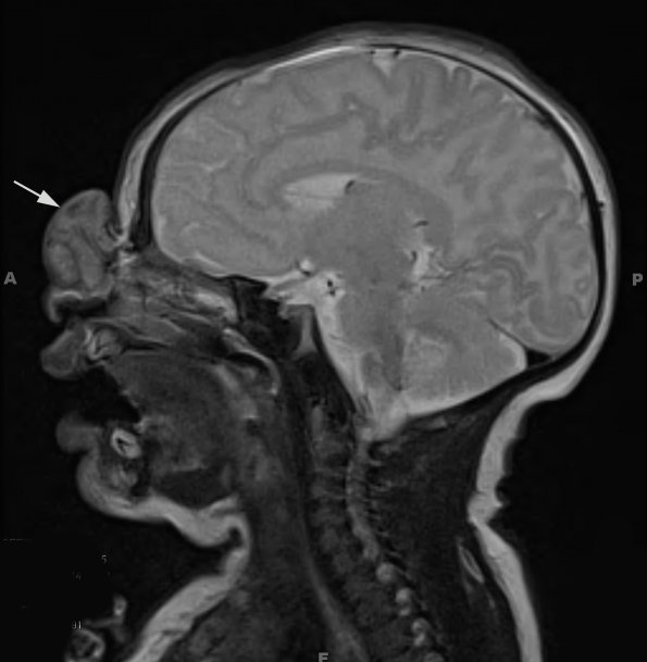 3A2 Encephalocele (no brain connection) Nasal Glioma (Case 3) T2