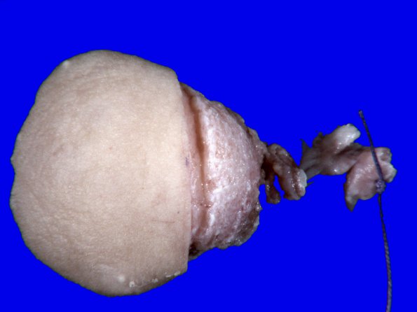 3B1 Encephalocele (no brain connection) Nasal Glioma (Case 3) Gross_1A