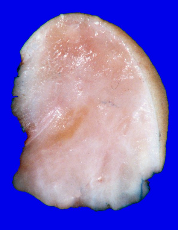 3B2 Encephalocele (no brain connection) Nasal Glioma (Case 3) Gross_1_2A