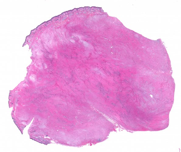 3C1 Encephalocele (no brain connection) Nasal Glioma (Case 3) H&E whole mount