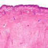 3C2 Encephalocele (no brain connection) Nasal Glioma (Case 3) H&E copy