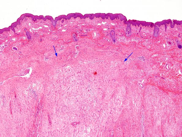 3C2 Encephalocele (no brain connection) Nasal Glioma (Case 3) H&E copy