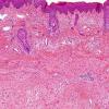 3C3 Encephalocele (no brain connection) Nasal Glioma (Case 3) H&E 1